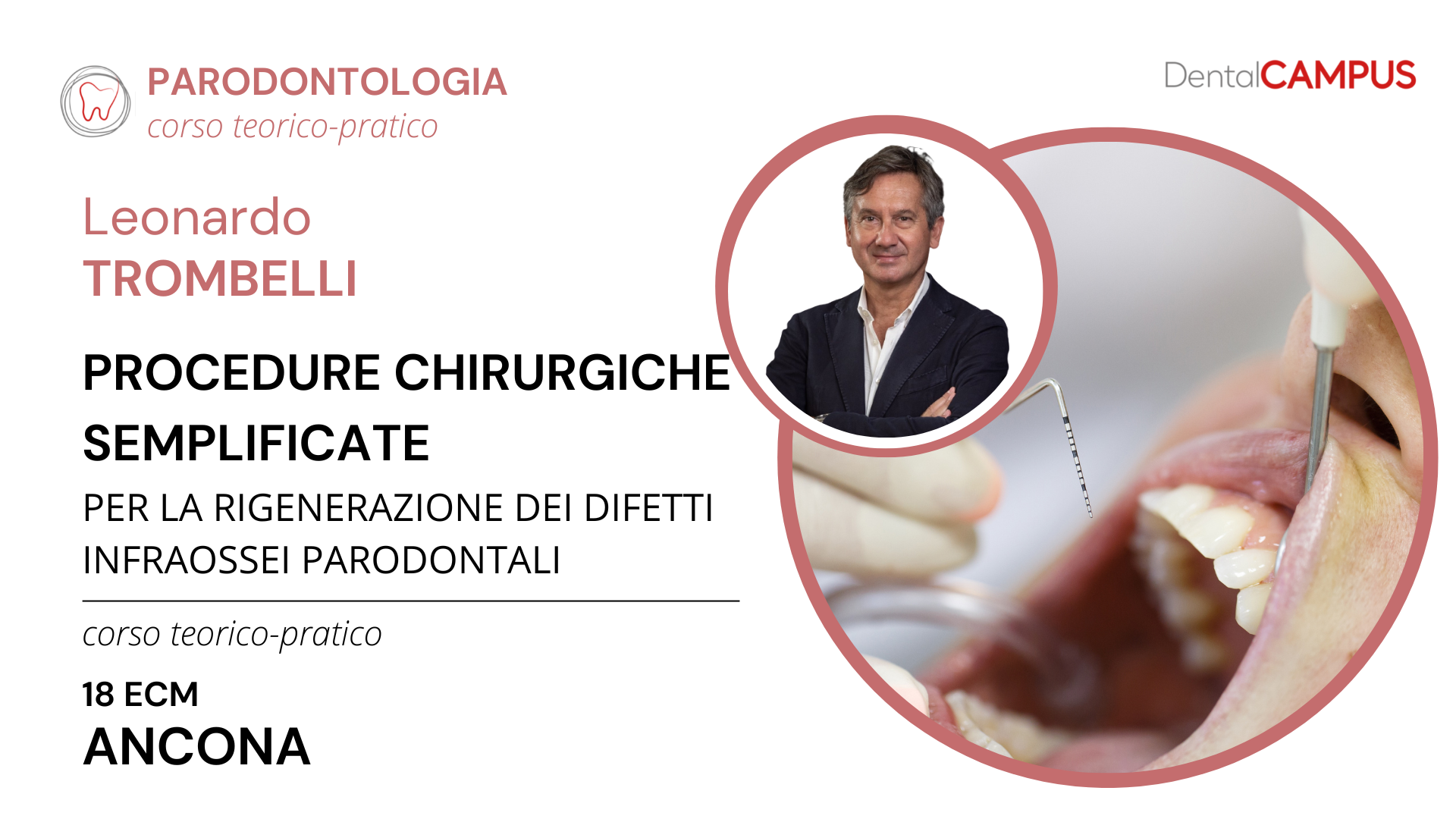 PROCEDURE CHIRURGICHE SEMPLIFICATE PER LA RIGENERAZIONE DEI DIFETTI INFRAOSSEI PARODONTALI