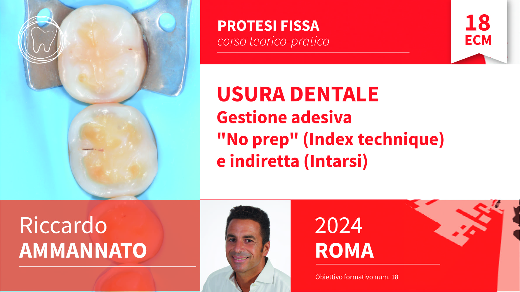 Faccette - Dr. Domenico Di Croce. Implantologia digitale
